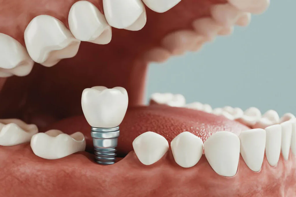  Implantes Dentários