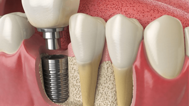  Implantes Dentários